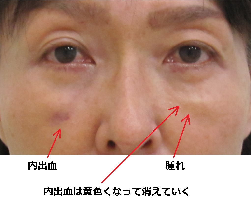 目の下の脱脂術後の出血 血の涙 内出血の予防法と対処法