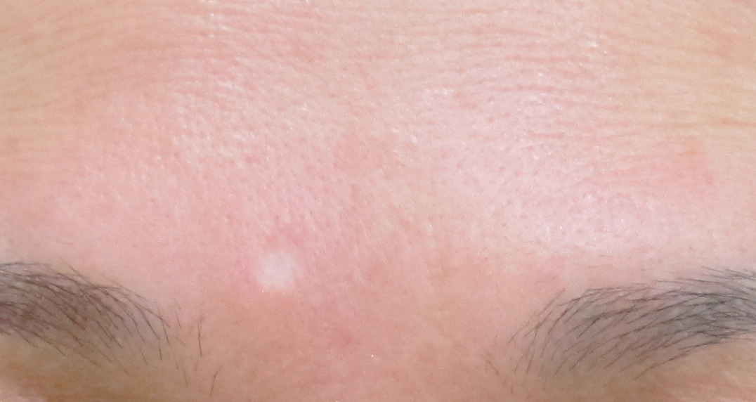 眉間のホクロ除去後のくぼみ治療 グロースファクター注入療法 8ヵ月後の経過